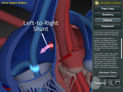 3D Road Map to ASD & VSD下载(iPad医疗)攻